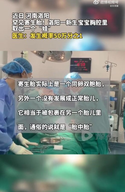 河南医生成功分离罕见胎中胎 网友：惊叹医学的进步